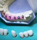 Implantat mit Druckknopf