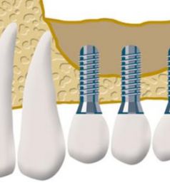 Implantat mit Knochenaufbau